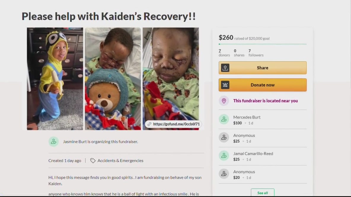 4-year-old boy attacked by loose dog in Detroit